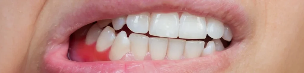 Por qué se inflaman las encías